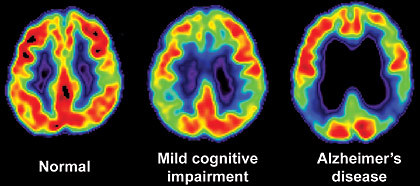 Understanding Why Dementia Changes Behaviour Understanding Why Dementia Changes Behaviour
